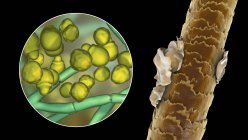 Ilustração do computador mostrando cabelo humano com caspa e visão de perto de fungos microscópicos Malassezia furfur associado com dermatite seborreica e formação de caspa — Fotografia de Stock