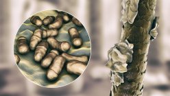 Illustrazione computerizzata che mostra i capelli umani con forfora e visione ravvicinata di funghi microscopici Malassezia furfur associata a dermatite seborroica e formazione di forfora — Foto stock