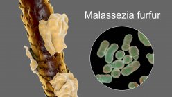 Комп'ютерна ілюстрація, що показує волосся людини з лупою та крупним планом мікроскопічних грибів Маласезія хутро, пов'язане з себорейним дерматитом та утворенням лупи — стокове фото