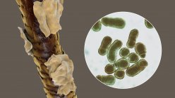 Ilustración por computadora que muestra el cabello humano con caspa y vista de cerca de hongos microscópicos Malassezia furfur asociado con la dermatitis seborreica y la formación de caspa - foto de stock