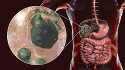 Гидатидные заболевания печени, вызванные личинками паразитического ленточного червя Echinococcus multilocularis, компьютерная иллюстрация — стоковое фото