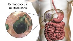 Hydatide hépatique causée par des larves de ténia parasite Echinococcus multilocularis, illustration par ordinateur — Photo de stock