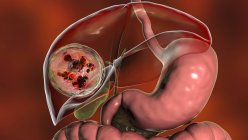 Hydatid disease in liver, cystic echinococcosis, Computer illustration — Stock Photo