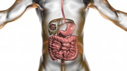 Enfermedad hidatídica en el hígado, equinococosis quística, ilustración por ordenador - foto de stock
