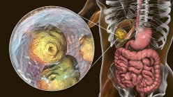 Doença hidática no fígado, equinococose cística, ilustração do computador — Fotografia de Stock