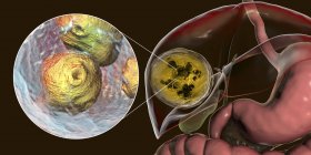 Hydatid-Krankheit in der Leber, zystische Echinokokkose, Computerillustration — Stockfoto