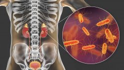 Akute Pyelonephritis. Illustration kleiner Abszesse (gelb) auf der Nierenoberfläche bei akuter Pyelonephritis — Stockfoto