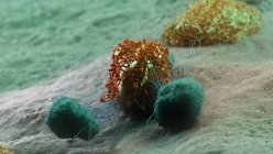 Células cancerosas atacadas por leucocitos, ilustración por computadora - foto de stock