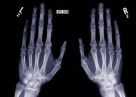 Two outstretched hands, X-ray. — Stock Photo