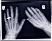 Hands with wedding ring on left hand, X-ray. — Stock Photo