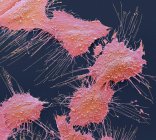 Раковые клетки костей. Цветной сканирующий электронный микрограф раковых клеток остеосаркомы. Остеосаркома - это агрессивная злокачественная новообразования, возникающие из примитивных трансформированных мезенхимальных клеток — стоковое фото