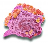 Lymphom-Krebszelle. Farbige Rasterelektronenmikroskopie (REM) einer Lymphomzelle, die frühe apoptotische Veränderungen zeigt. Ein Lymphom ist eine Zelle des Immunsystems, die krebserregend geworden ist. Die Zelle wird unsterblich und kann unbegrenzt wachsen — Stockfoto
