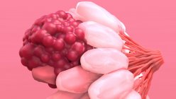 Рак груди. Иллюстрация злокачественной (раковой) опухоли (красной) в женской груди — стоковое фото