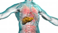 Liver with cirrhosis, computer illustration. Cirrhosis is a consequence of chronic liver disease characterized by fibrosis and scarring of tissue — Stock Photo
