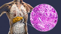 Цироз печінки. Комп'ютерна ілюстрація та легкий мікрограф ділянки через печінку людини з цирозом, що показує фіброз та відсутність функціональної анатомії печінки . — стокове фото