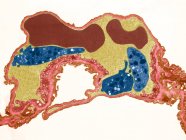 Tejido pulmonar, micrografía electrónica de transmisión coloreada (TEM). Capilar pulmonar que contiene dos glóbulos rojos (rojo) y tres plaquetas (azul). Una membrana basal (rosa) rodea el endotelio que lo separa del epitelio alveolar - foto de stock