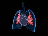 Viral lung infection, illustration. Inflamed lungs infected with virus particles. — Stock Photo