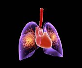 Viral lung infection, illustration. Inflamed lungs infected with virus particles. — Stock Photo