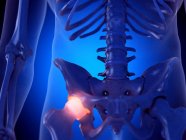 Painful hip joint, computer illustration — Stock Photo