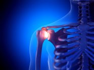 Painful shoulder joint, computer illustration — Stock Photo