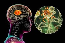 Gehirnschleimhaut, eine durch Mucor sp verursachte Hirnläsion. Pilze, auch als schwarzer Pilz bekannt, mit Nahaufnahme von Pilzen, Computerillustration. Mucor sp. Pilze kommen im Boden und in zerfallenden organischen Substanzen vor und sind häufige Schimmelpilze in Innenräumen — Stockfoto