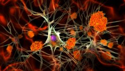 Alzheimer's disease. Illustration of amyloid plaques amongst neurons and neurofibrillary tangles inside neurons. Amyloid plaques are characteristic features of Alzheimer's disease — Foto stock