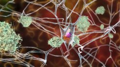 Болезнь Альцгеймера. Иллюстрация амилоидных бляшек между нейронами и нейрофибриллярными клубками внутри нейронов. Амилоидные бляшки являются характерными чертами болезни Альцгеймера — стоковое фото