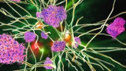 Болезнь Альцгеймера. Иллюстрация амилоидных бляшек между нейронами и нейрофибриллярными клубками внутри нейронов. Амилоидные бляшки являются характерными чертами болезни Альцгеймера — стоковое фото