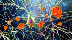La enfermedad de Alzheimer. Ilustración de placas amiloides entre neuronas y enredos neurofibrilares dentro de neuronas. Las placas amiloides son características de la enfermedad de Alzheimer. - foto de stock