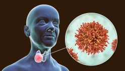 Рак щитовидної залози із зображенням ракових клітин на комп 