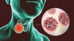 Cancer de la glande thyroïde avec vue rapprochée des cellules cancéreuses, illustration par ordinateur. — Photo de stock