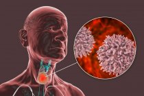 Рак щитовидної залози із зображенням ракових клітин на комп 