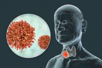 Рак щитовидной железы с крупным планом раковых клеток, компьютерная иллюстрация. — стоковое фото