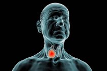 Tumor de la glándula tiroides, ilustración por ordenador. - foto de stock
