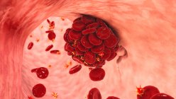 Illustration eines Blutgerinnsels in beschädigten Blutgefäßen aus roten Blutkörperchen, Blutplättchen und Fibrin-Proteinsträngen. — Stockfoto