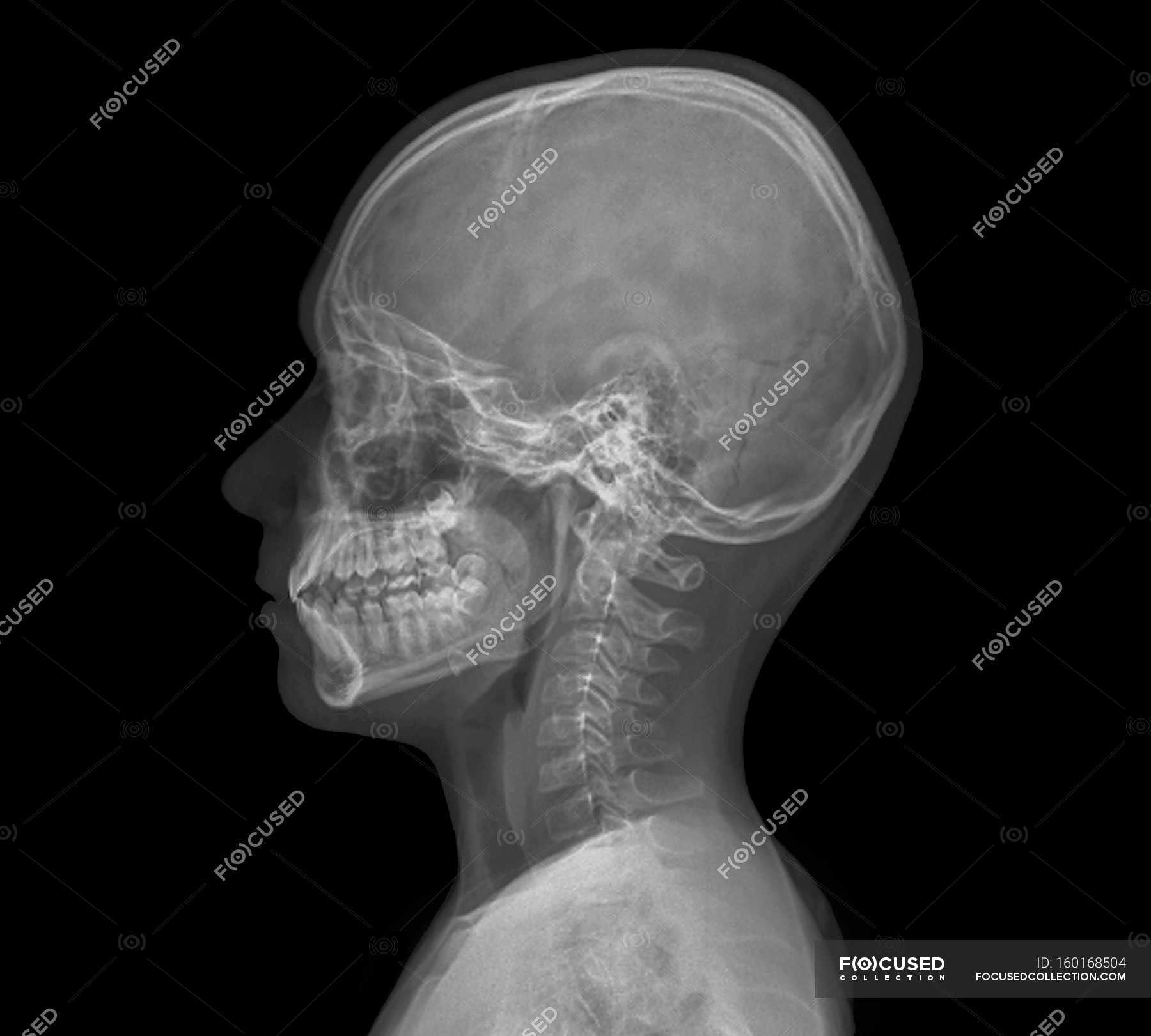 Normal child head. Xray of the head of a 13 year old. — side view
