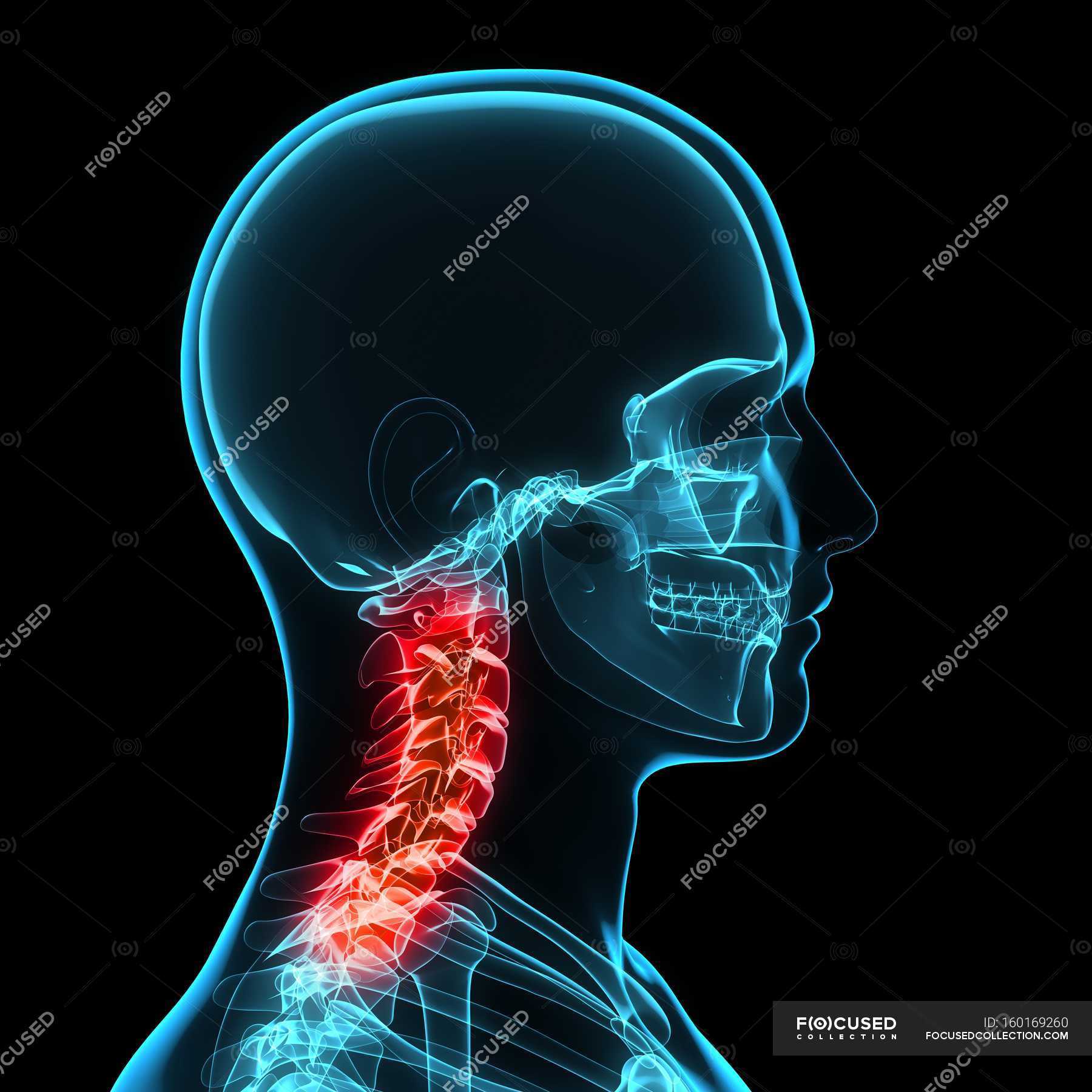 neck-pain-affecting-cervical-vertebrae-joints-abnormal-stock-photo