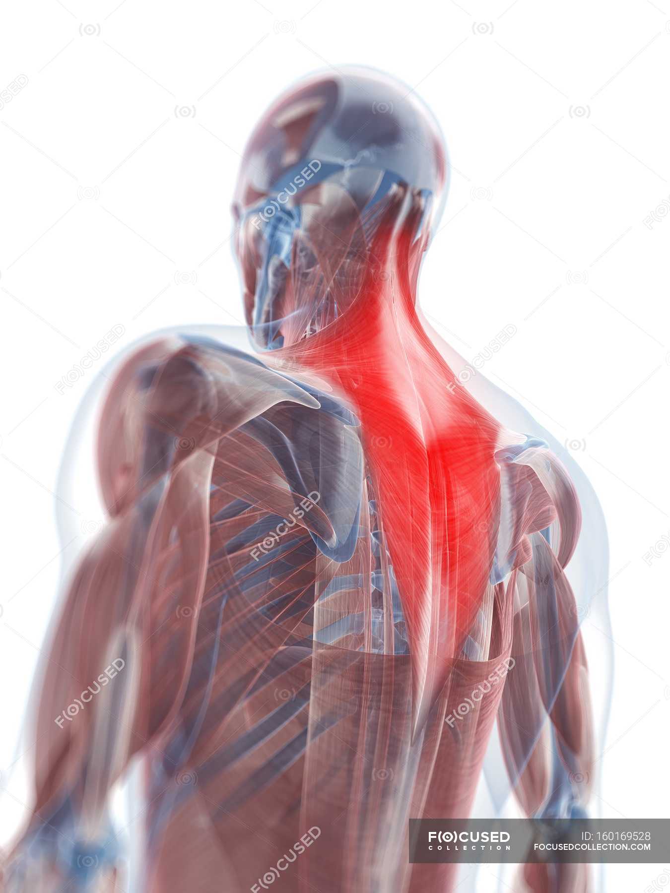 Large Trapezius Muscle