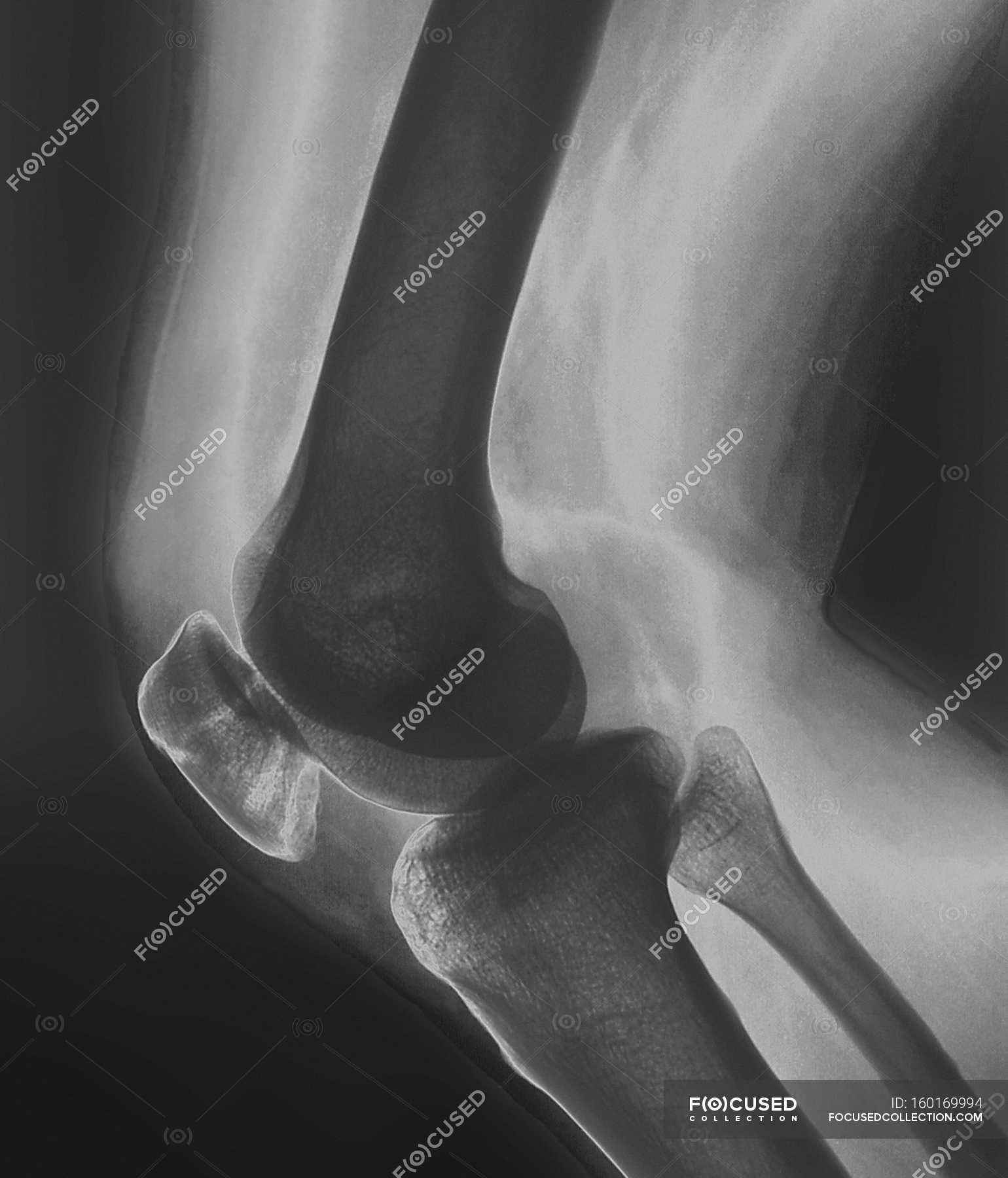 Трещина в коленной. Перелом надколенника рентген. Рентгенография коленной чашечки. Рентген коленной чашечки.