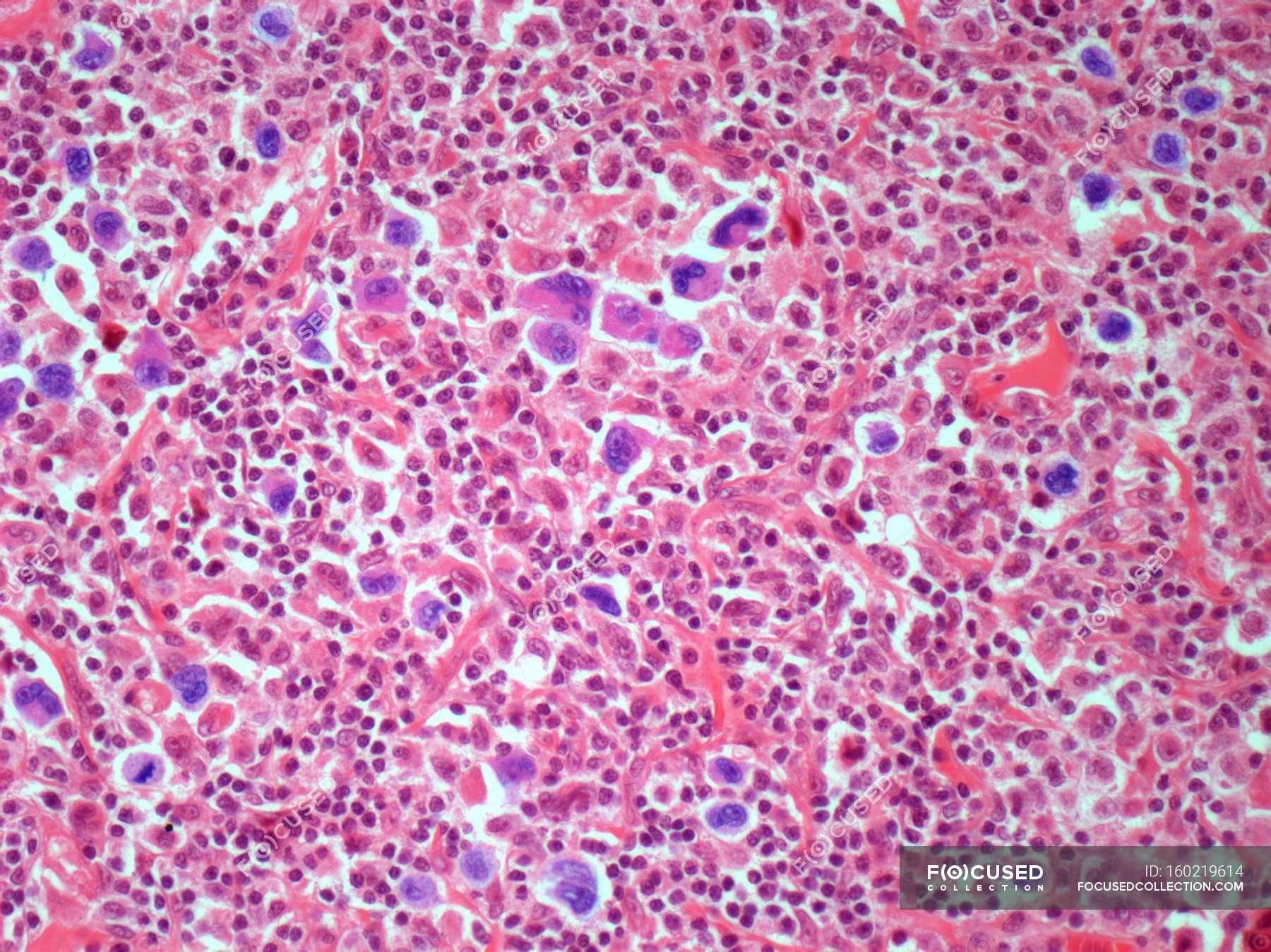Light Micrograph Of A Section Through A Lymph Node Affected By Hodgkin Light Micrograph Of A Section Through A Lymph Node Affected By Hodgkin