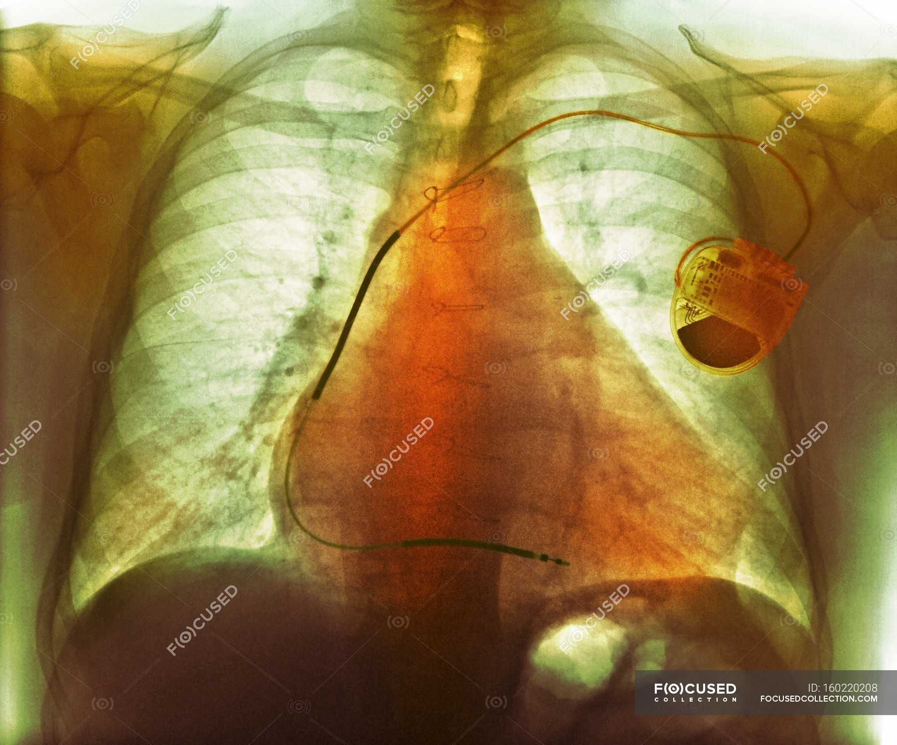 Pacemaker and congestive heart failure doctorvisit