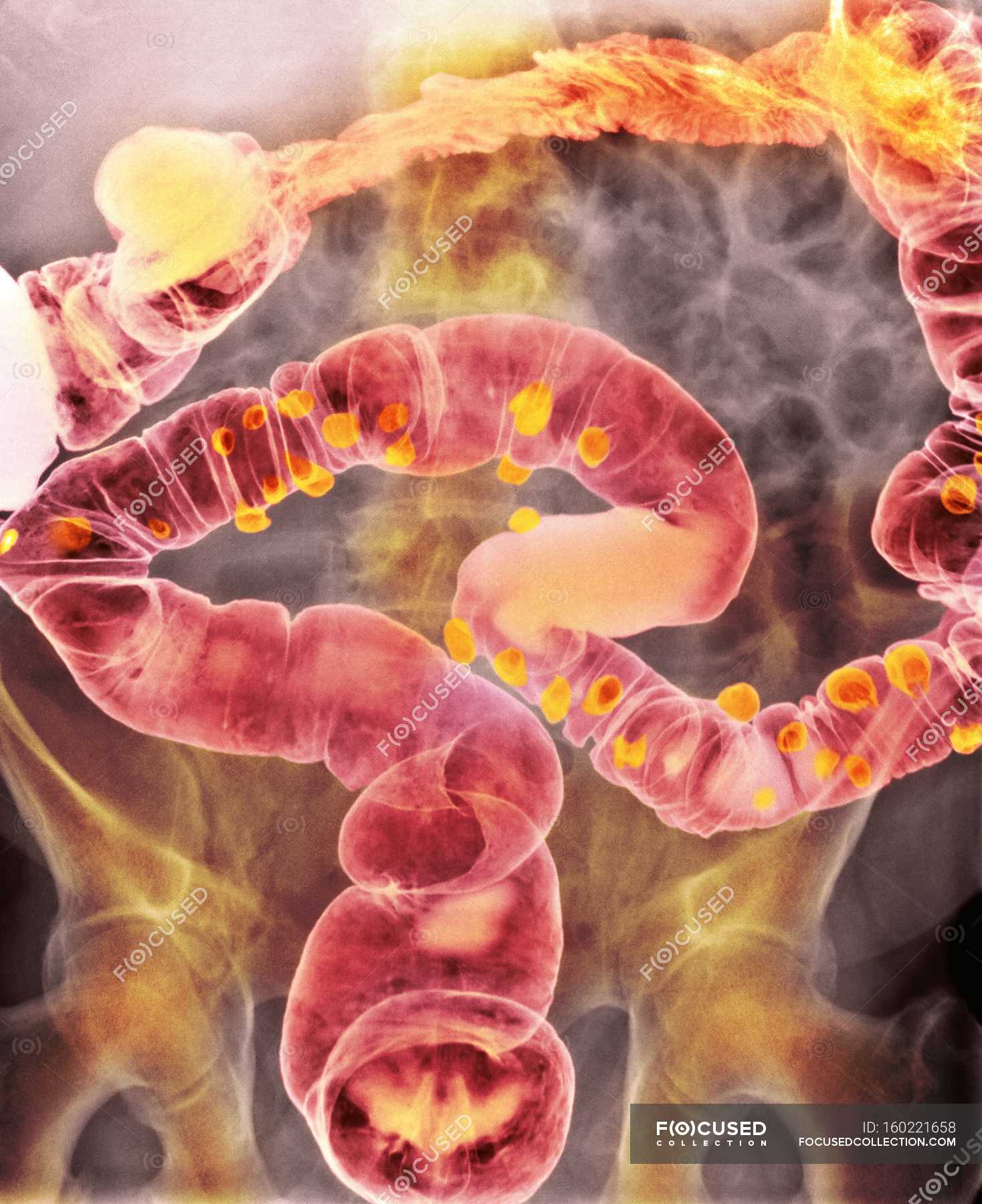 Paciente Con Diverticulitis — Radiografía Imágenes Científicas Stock