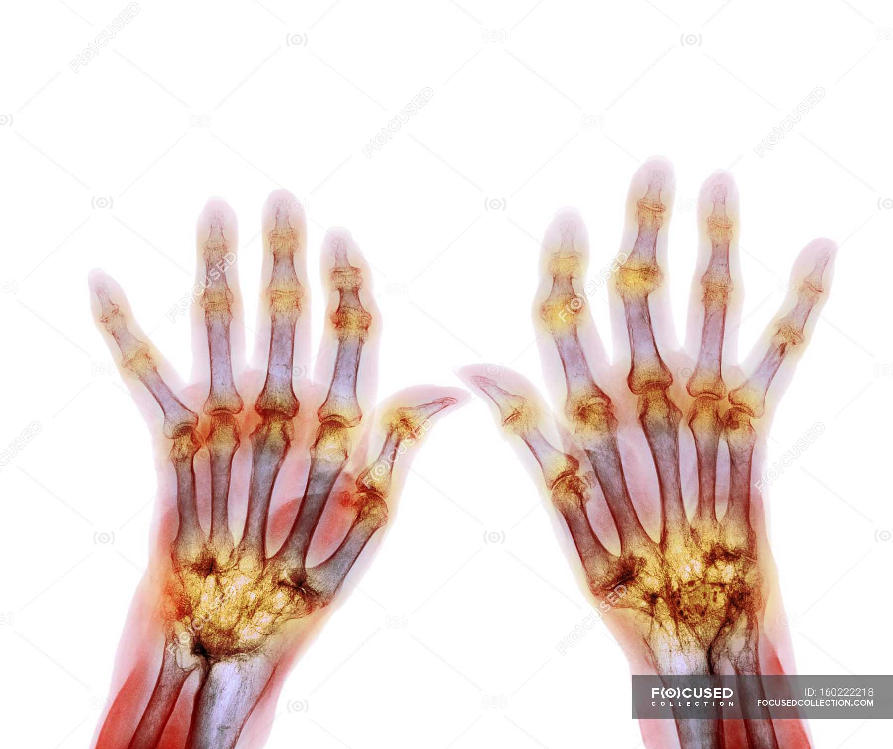 korai stádiumú rheumatoid arthritis