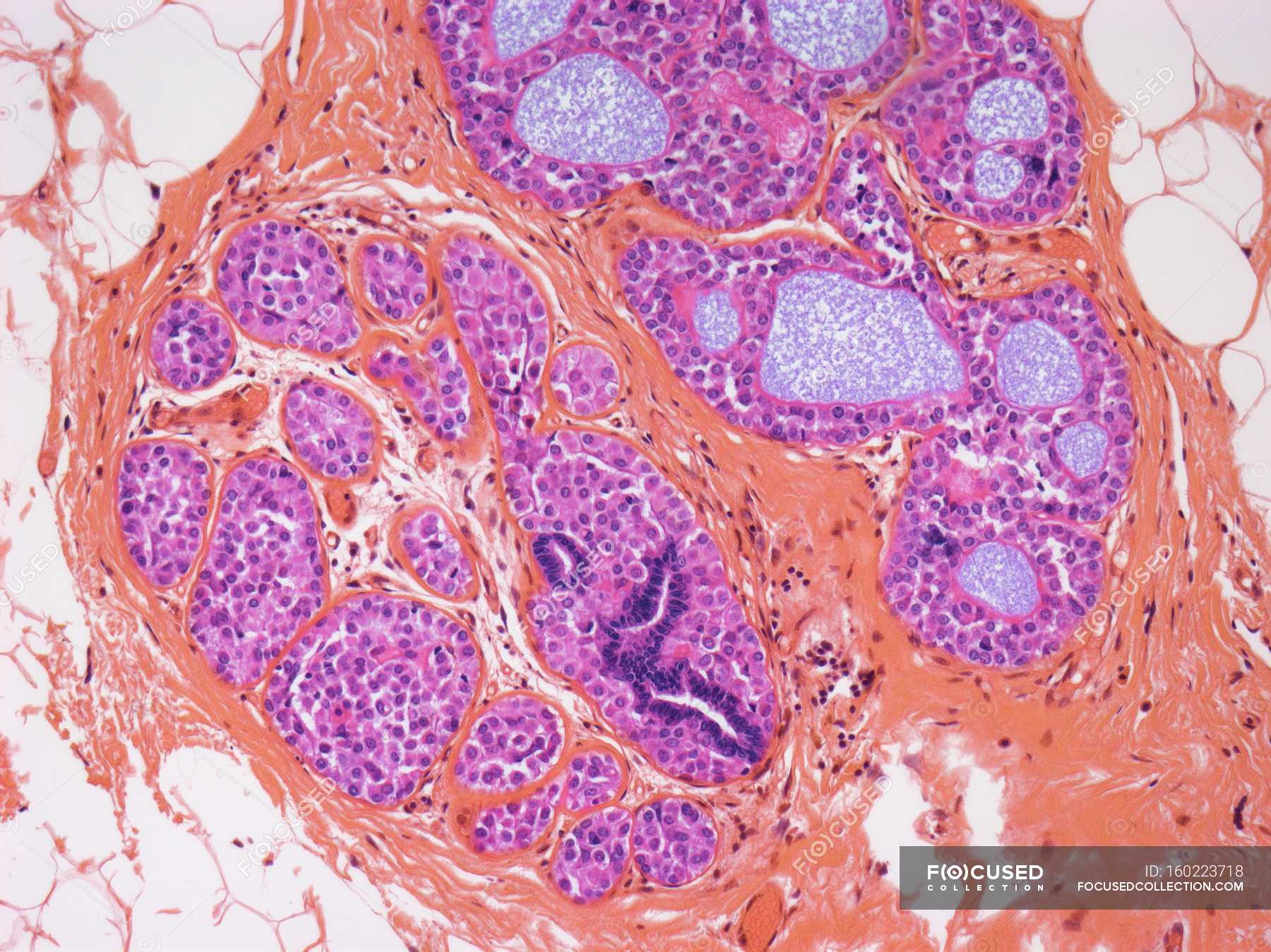 breast-with-lobular-carcinoma-lobular-neoplasia-physiology-stock