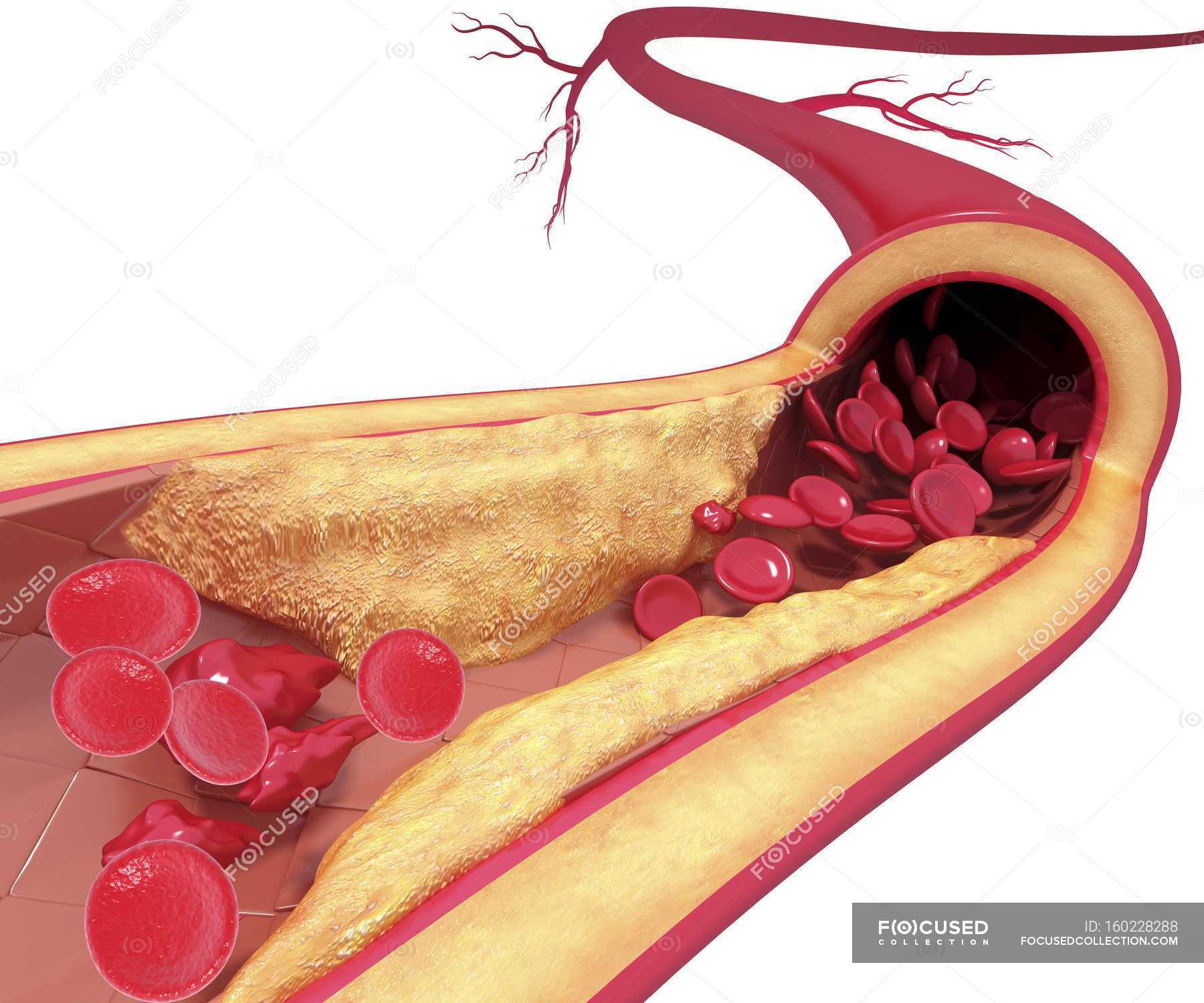 cholesterol-plaque-leading-to-atherosclerosis-white-background-close