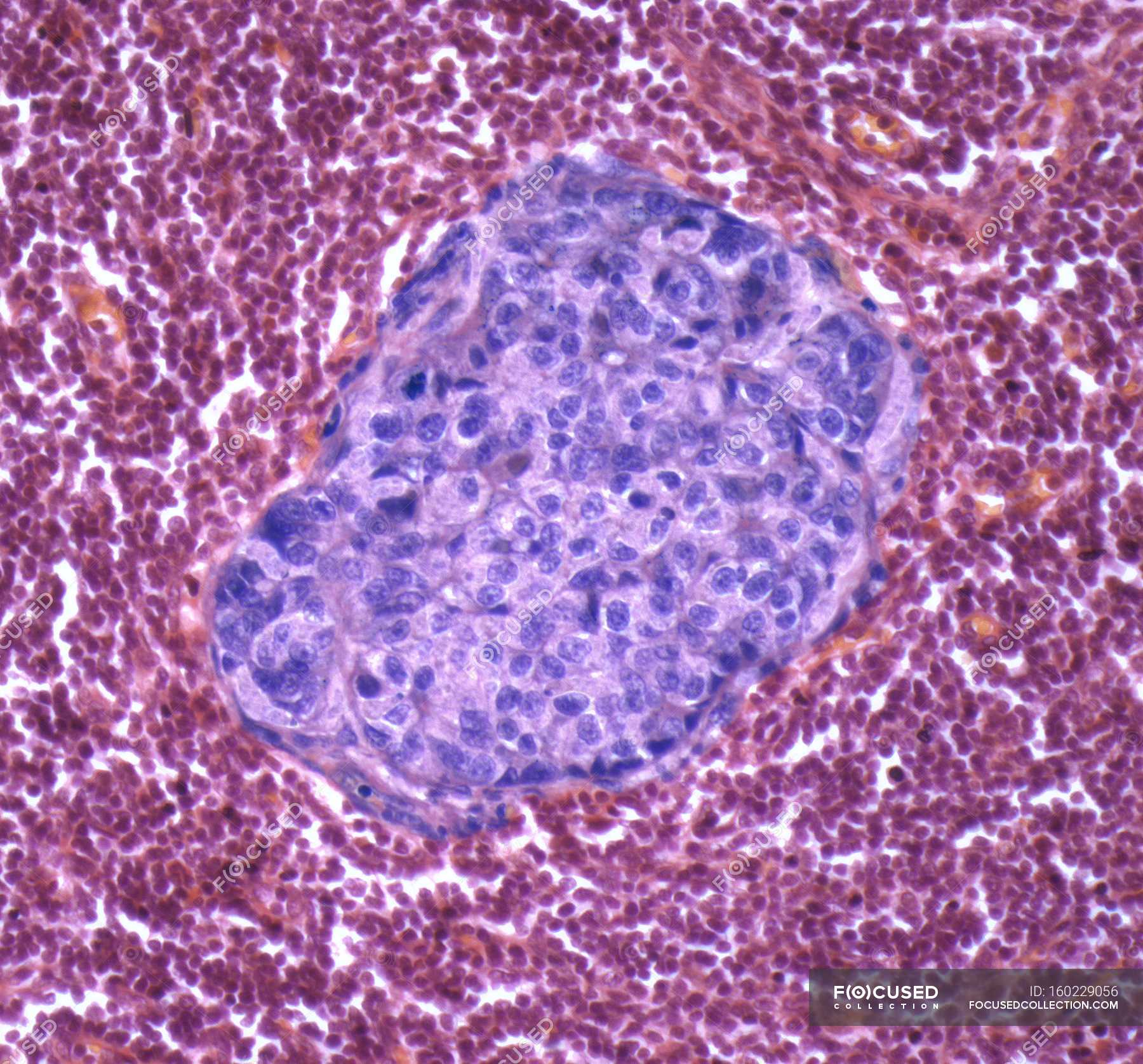 shotty metastatic lymph nodes