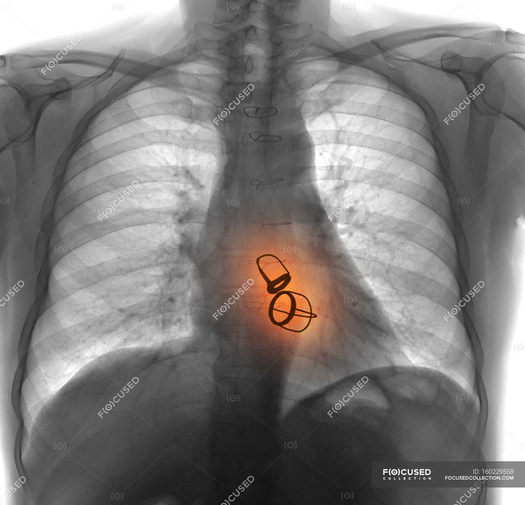 Как клапан делает операция. Протезы клапанов сердца на рентгене. Искусственный клапан сердца рентген. Аортальный клапан рентген. Искусственный аортальный клапан рентген.