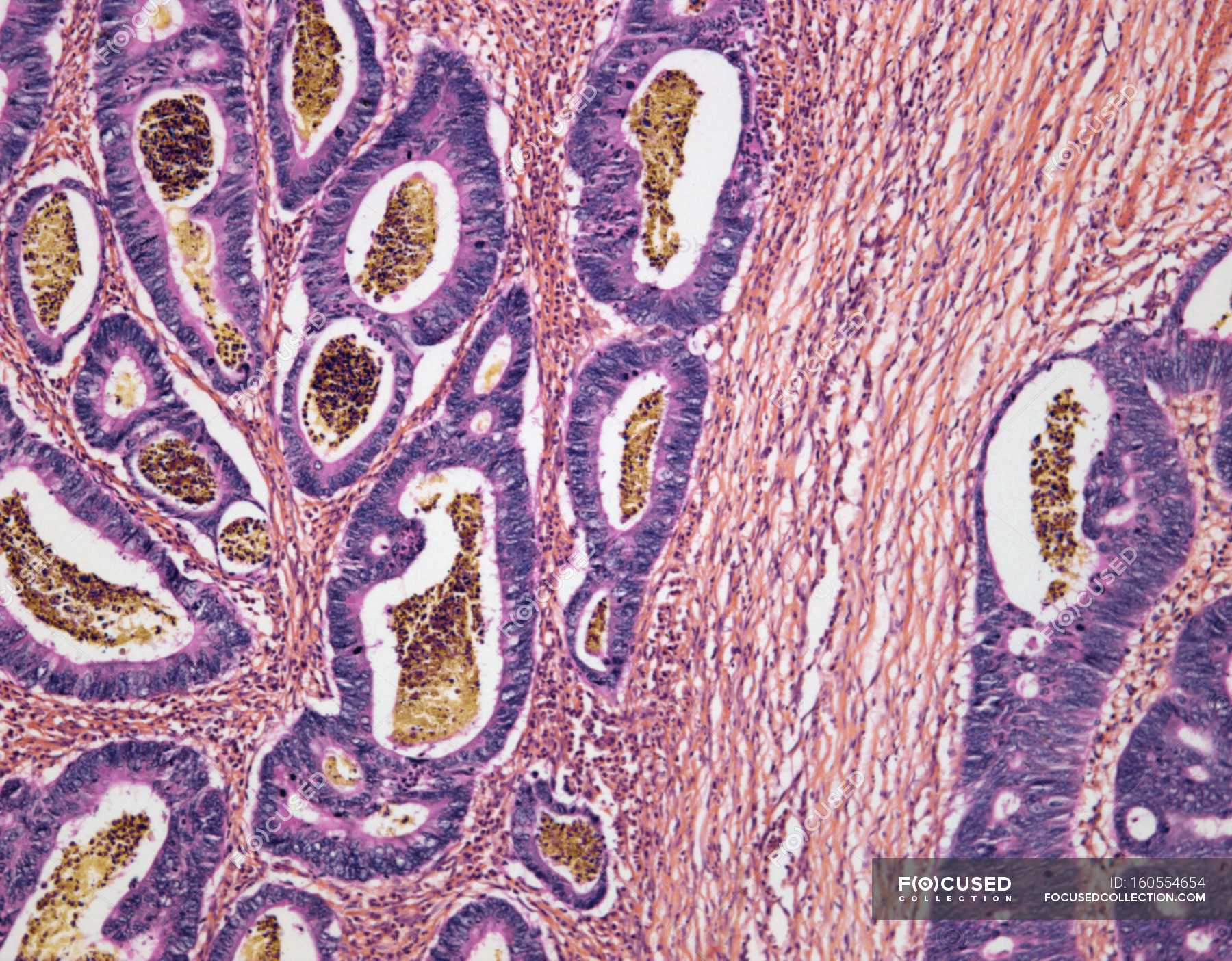 Adenocarcinoma of the sigmoid colon — digestive system, section Stock Photo 160554654 Adenocarcinoma of the sigmoid colon — digestive system, section Stock Photo 160554654