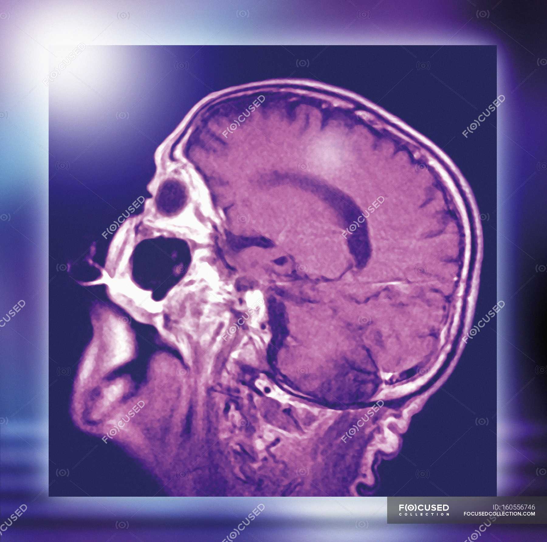 normal-head-and-brain-mri-scan-scanner-biological-stock-photo
