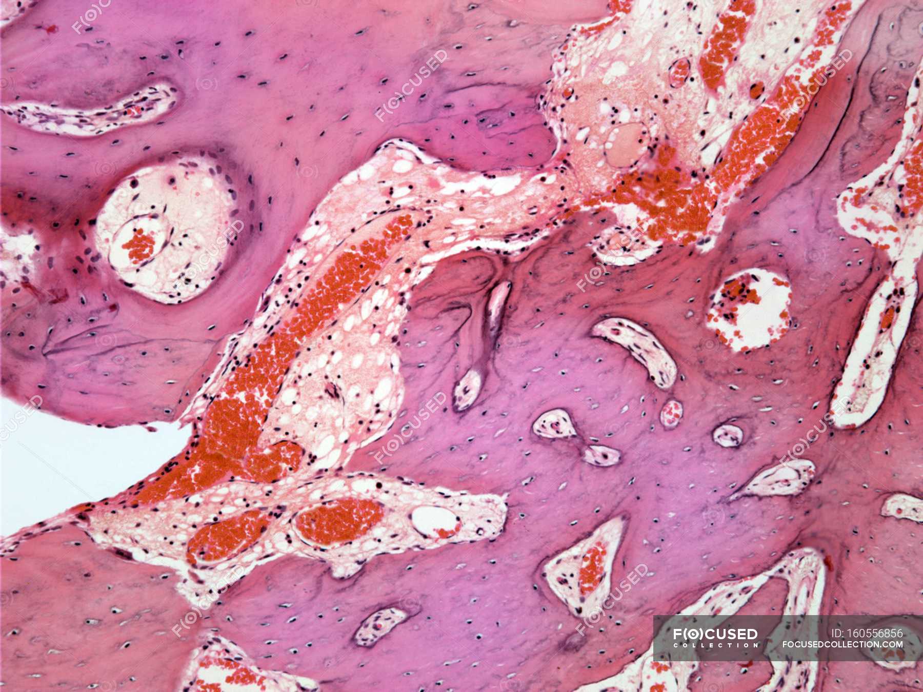 Section through an osteoid osteoma — bone, non cancerous - Stock Photo ...